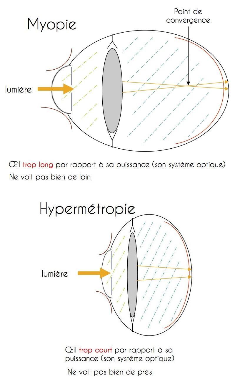 L'œil de myope et l'œil d'hypermétrope